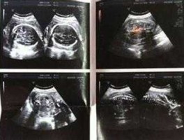 小派科技？云小派上传b超单安全吗？