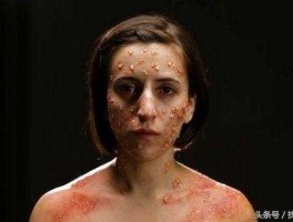 天花疫苗概念股（古代的天花，现在叫什么？）