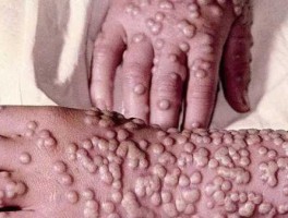 天花疫苗概念股，古代的天花，现在叫什么？