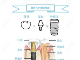 种植牙吧（种植牙是怎么种植的？）